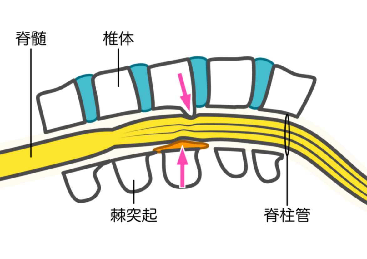 脊柱管狭窄症の原因
