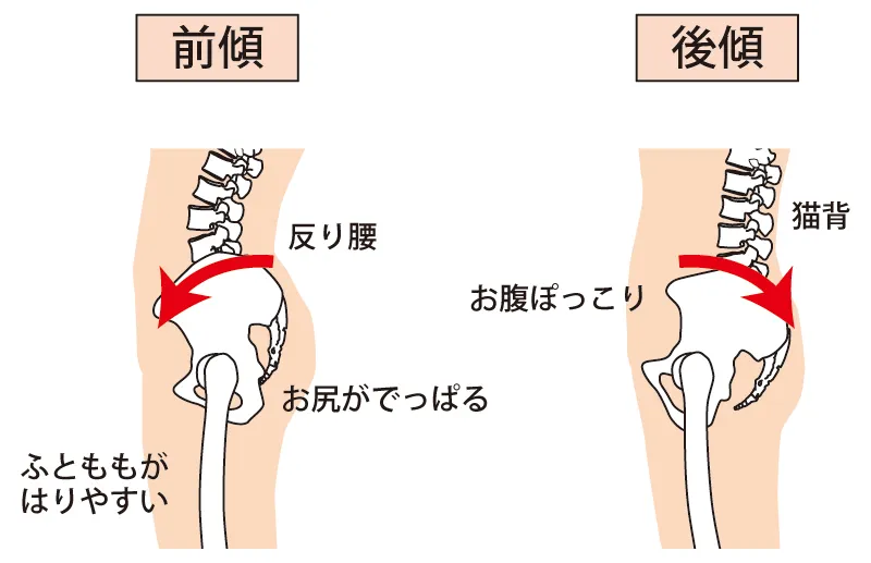 骨盤が前に傾く反り腰と、後ろに傾く姿勢の違い